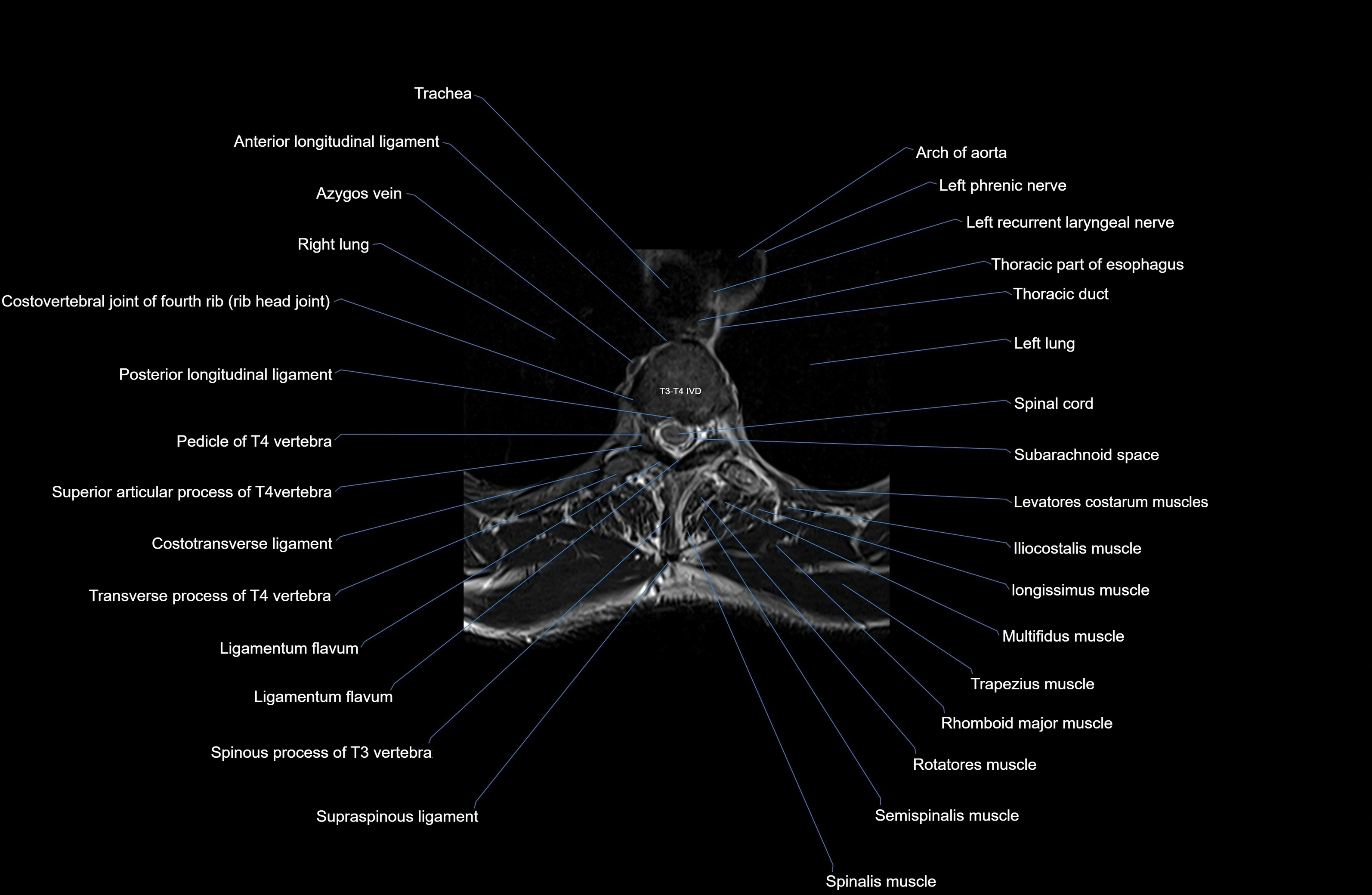 MRI thoracic spine axial  cross sectional anatomy 3T radiology  image-img-00001-00023.webp